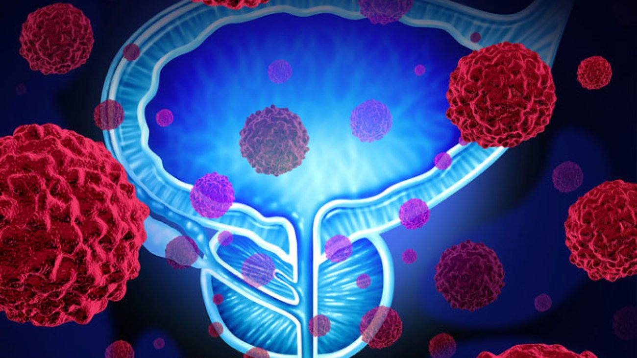 Prostate-tumor (1)