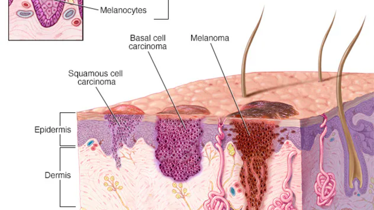 ds00190_-ds00439_-ds00924_-ds00925_im02400_c7_skincancerthu_jpg
