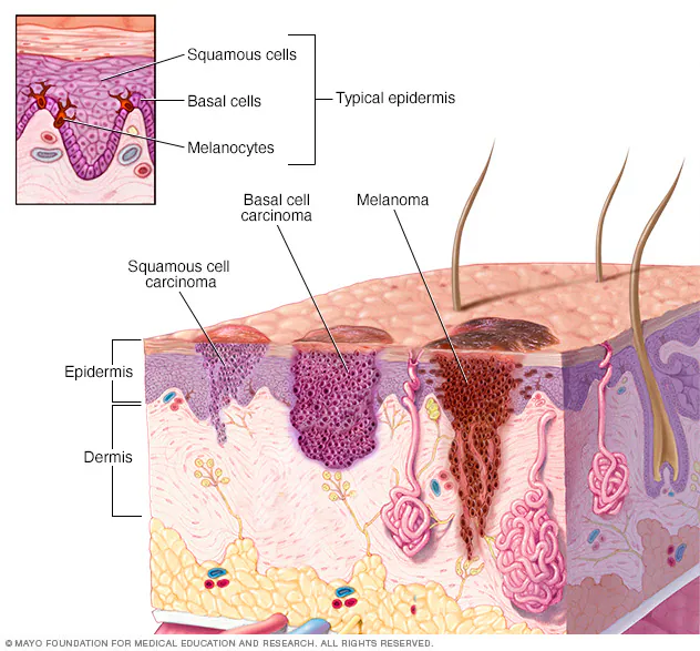 ds00190_-ds00439_-ds00924_-ds00925_im02400_c7_skincancerthu_jpg