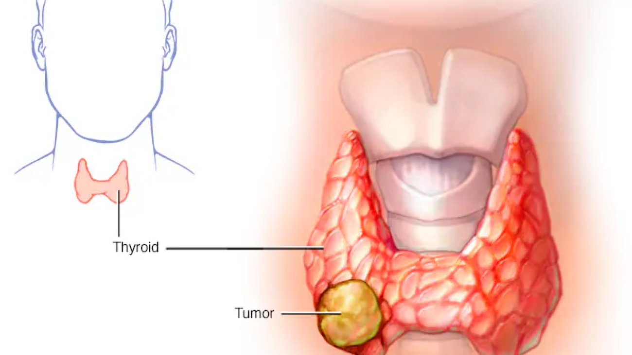 ds00492_im03899_c7_thyroidcancerthu_jpg