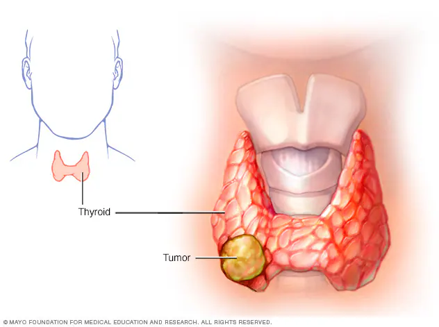 ds00492_im03899_c7_thyroidcancerthu_jpg