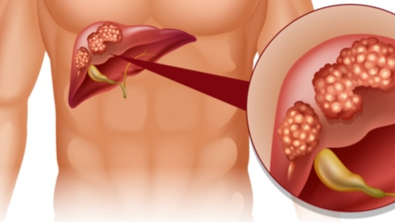 tbl_diseases_disease_130_410ef3901ce-e06d-404f-baf3-349560890427