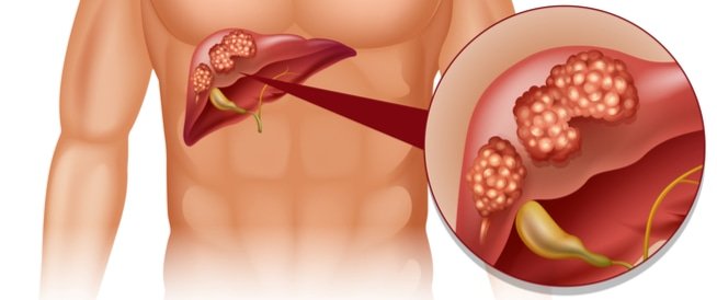 tbl_diseases_disease_130_410ef3901ce-e06d-404f-baf3-349560890427