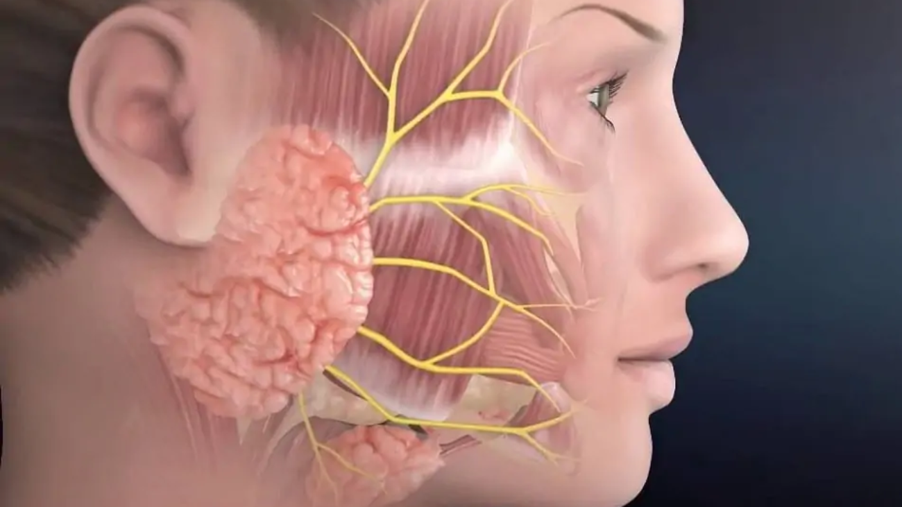 استئصال-ورم-من-الغدة-النكافية-والحفاظ-على-العصب-السابع-parotidectomy-surgery